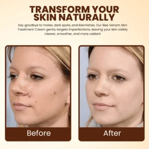 Lyyeto® Bee Venom Skin Treatment Cream