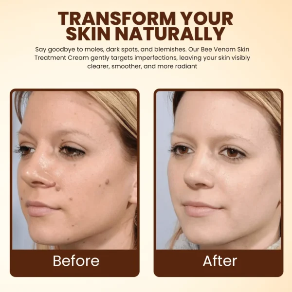 Lyyeto® Bee Venom Skin Treatment Cream