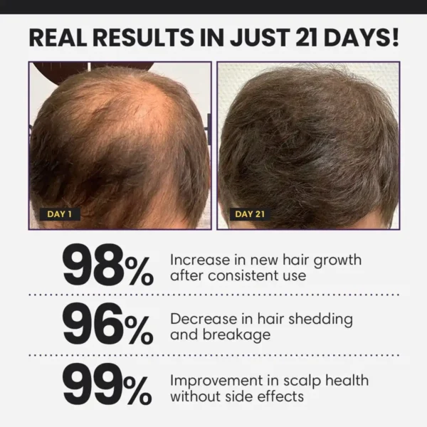 Lyyeto® FollicleBoost 5X Hair Growth Serum
