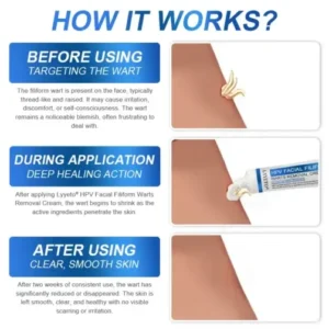 LYYETO® HPV Facial Filiform Warts Removal Cream