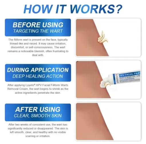 LYYETO® HPV Facial Filiform Warts Removal Cream