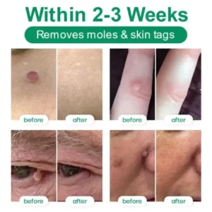 Lyyeto® Herdle Shot Spot & Mole Correct Serum