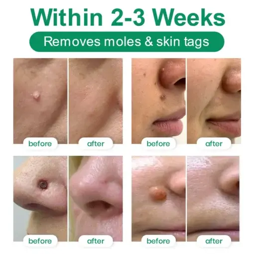 Lyyeto® Herdle Shot Spot & Mole Correct Serum